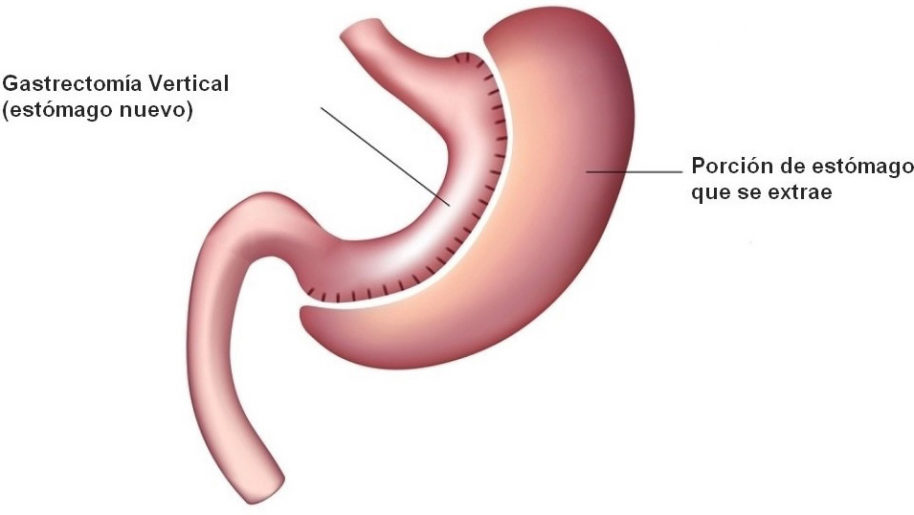 gastrectomia | Valencia Quirúrgica | Hernia Centre