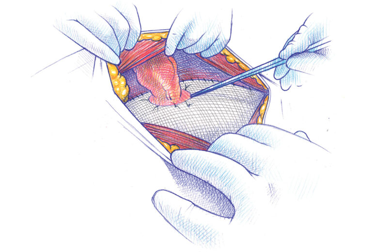 Hernia Del Estoma O Hernia Paraestomal Valencia Quir Rgica Hernia Centre